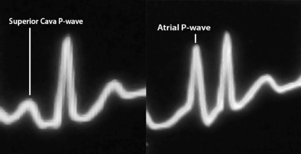 Figura 2 - Difference between superior cava and endoatrial conformation of endocavitary ECG P-waves  Differenza tra la forma dell’onda P endocavitaria in vena cava superior ed in atrio destroy 