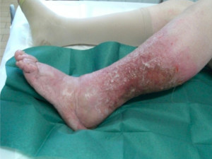 Figura 5 - Ulcera venosa linfatica